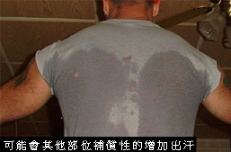 狐臭-汗腺發達-miradry-多汗-流汗-微舒淨-腋淨爽-神經截斷術