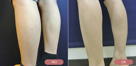 瘦小腿-纖纖美腿-纖纖小腿前後對比圖