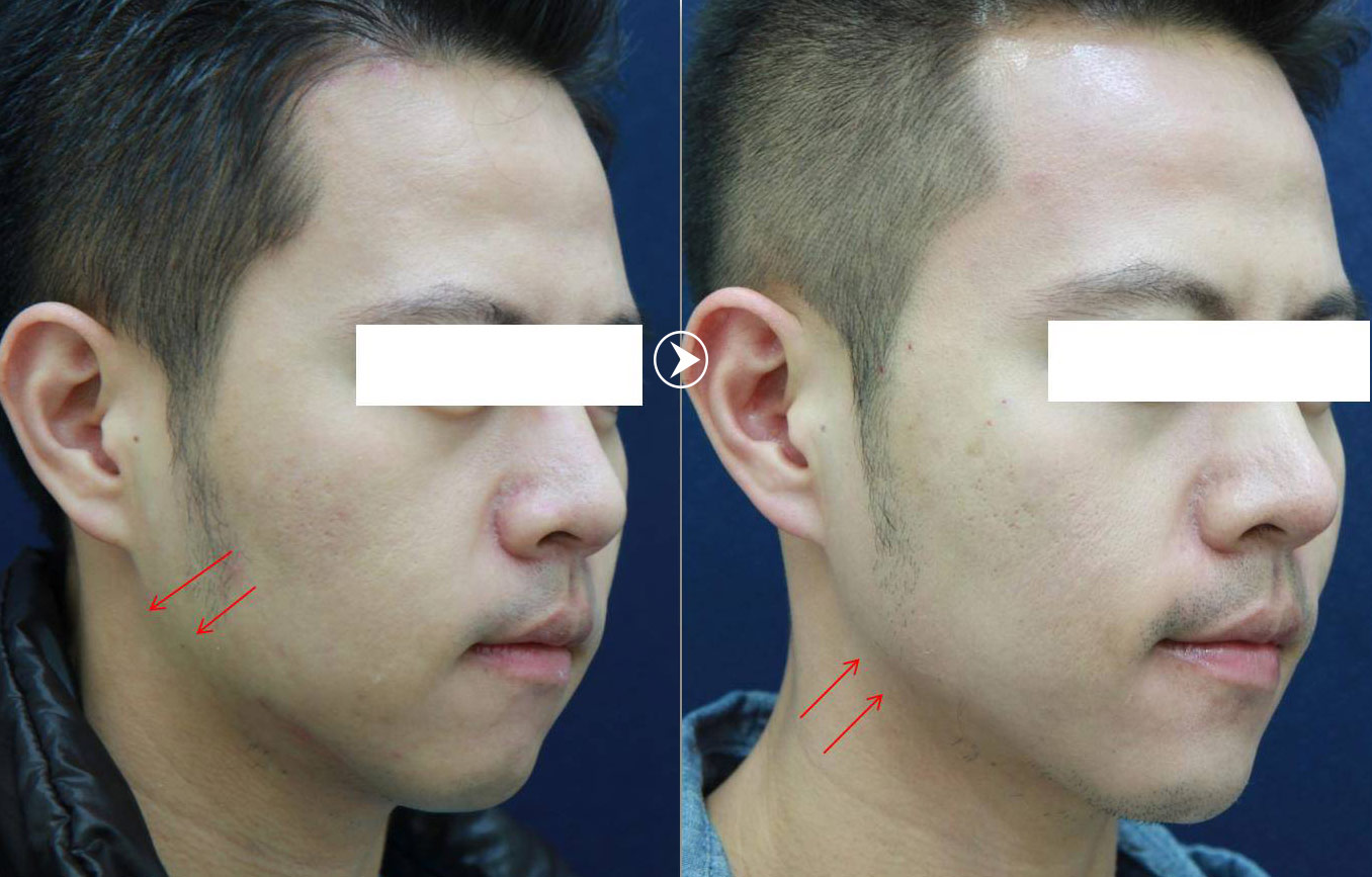 彤顏診所-雙波拉提-音波拉皮-電波拉皮-老化-皺紋-電波拉提-音波拉提-抗老-除皺-青春