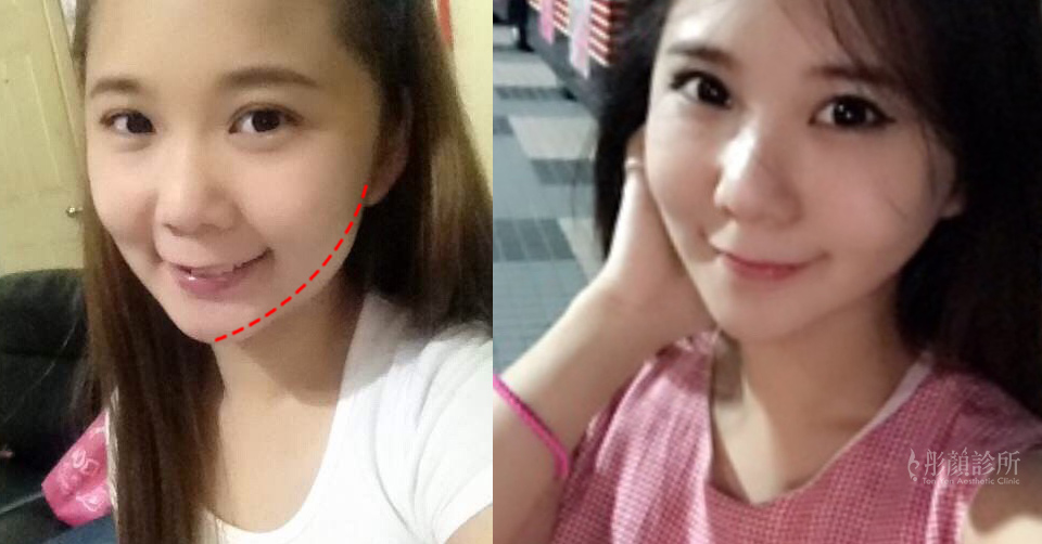 小臉V-V型臉-方形臉-V下巴-圓臉-BABY FAT-瘦臉-嘴邊肉-雙下巴