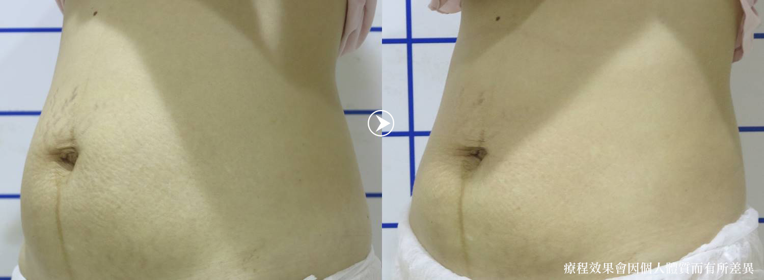 彤顏診所-減肥-減重-瘦身-隔空減脂-電波減脂-體外減脂-貴妃減脂-溶脂-vanquish-瘦大腿-瘦小腹-瘦腰