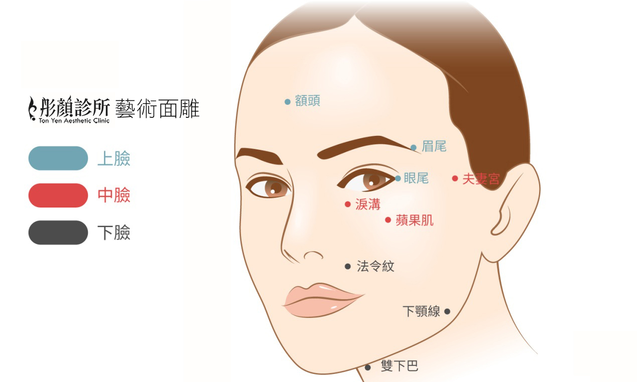 蘋果肌-法令紋-藝術面雕-彤顏診所-玻尿酸-依戀詩-童顏針-水微晶-晶亮瓷-二代童顏針-心型臉-微整形-淚溝-夫妻宮-玻尿酸價格-玻尿酸費用