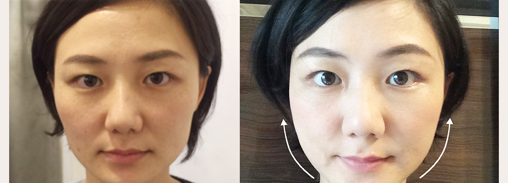 蘋果肌-法令紋-藝術面雕-彤顏診所-玻尿酸-依戀詩-童顏針-水微晶-晶亮瓷-4d童顏針-心型臉-微整形-淚溝-夫妻宮-玻尿酸價格-玻尿酸費用