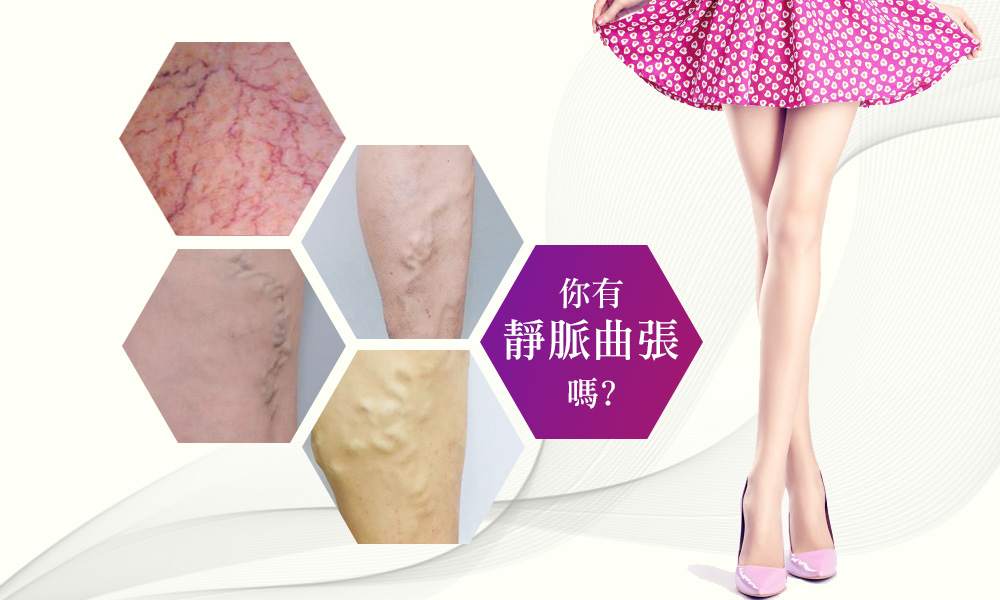 靜脈曲張-浮青筋-小腿爆青筋-靜脈曲張改善-血管絲-空姐愛用-櫃姐愛用-靜脈曲張治療-體表血管雷射-微創血管手術-靜脈內雷射治療-皮膚管理專家-彈性襪