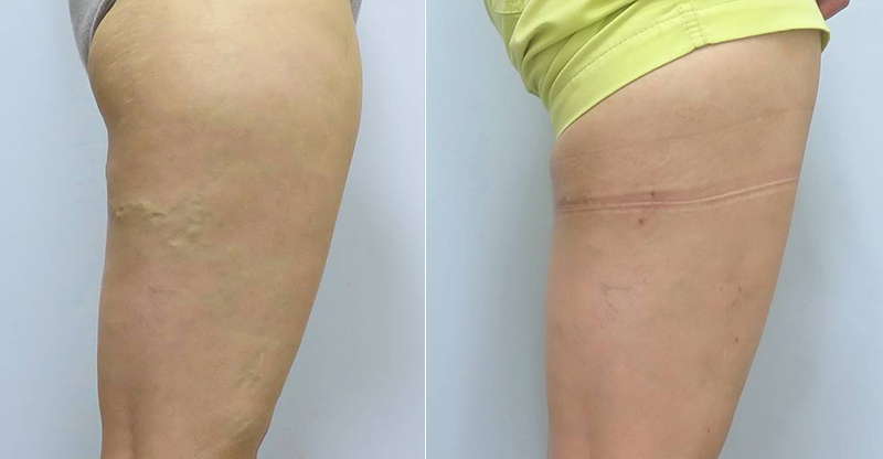 靜脈曲張-浮青筋-小腿爆青筋-靜脈曲張改善-靜脈曲張治療-體表血管雷射-微創血管手術-靜脈內雷射治療-EVLT-皮膚管理專家-靜脈曲張手術推薦-靜脈曲張手術費用