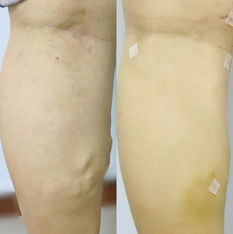 靜脈曲張-浮青筋-小腿爆青筋-靜脈曲張改善-靜脈曲張治療-體表血管雷射-微創血管手術-靜脈內雷射治療-EVLT-皮膚管理專家-靜脈曲張手術推薦-靜脈曲張手術費用