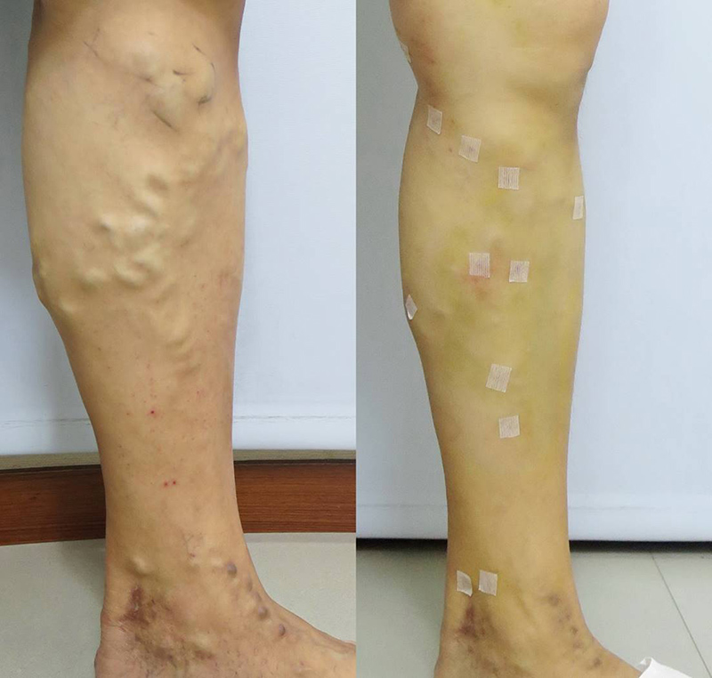 靜脈曲張-浮青筋-小腿爆青筋-靜脈曲張改善-靜脈曲張治療-體表血管雷射-微創血管手術-靜脈內雷射治療-EVLT-皮膚管理專家-靜脈曲張手術推薦-靜脈曲張手術費用