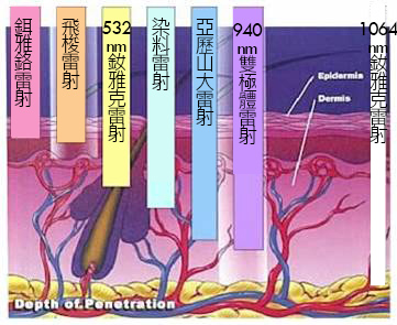 靜脈曲張-浮青筋-小腿爆青筋-靜脈曲張改善-靜脈曲張治療-體表血管雷射-微創血管手術-靜脈內雷射治療-EVLT-皮膚管理專家-靜脈曲張手術推薦-靜脈曲張手術費用