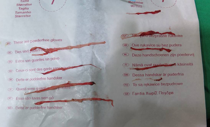 靜脈曲張-浮青筋-小腿爆青筋-靜脈曲張改善-靜脈曲張治療-體表血管雷射-微創血管手術-靜脈內雷射治療-EVLT-皮膚管理專家-靜脈曲張手術推薦-靜脈曲張手術費用