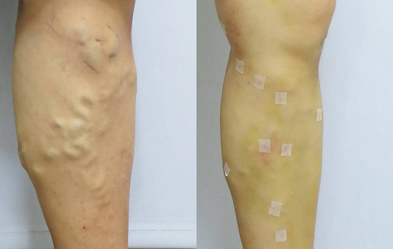 靜脈曲張-浮青筋-小腿爆青筋-靜脈曲張改善-靜脈曲張治療-體表血管雷射-微創血管手術-靜脈內雷射治療-EVLT-皮膚管理專家-靜脈曲張手術推薦-靜脈曲張手術費用