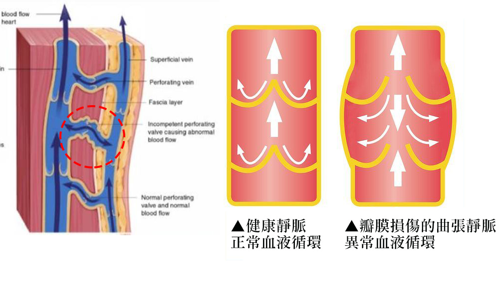 靜脈曲張-浮青筋-小腿爆青筋-靜脈曲張改善-血管絲-空姐愛用-櫃姐愛用-靜脈曲張治療-體表血管雷射-微創血管手術-靜脈內雷射治療-皮膚管理專家-靜脈曲張怎麼辦-彈性襪