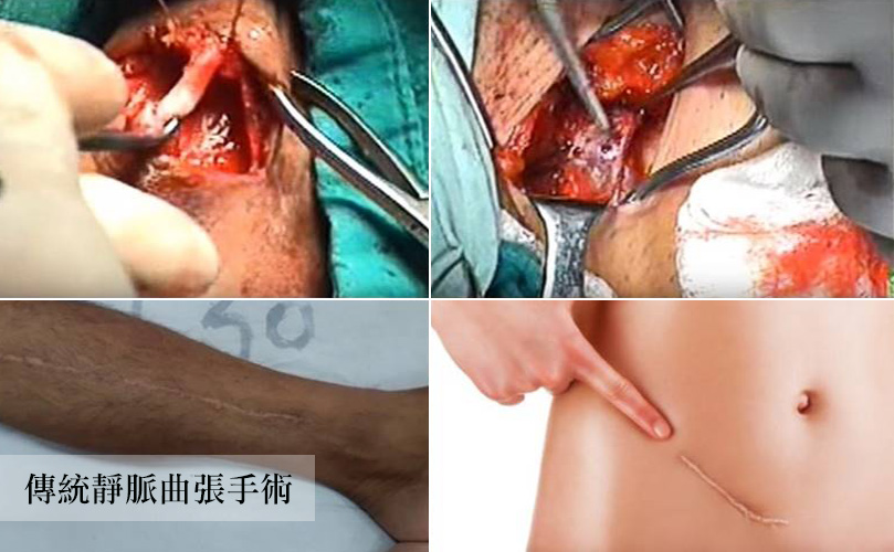 靜脈曲張-浮青筋-小腿爆青筋-靜脈曲張改善-血管絲-空姐愛用-櫃姐愛用-靜脈曲張治療-體表血管雷射-微創血管手術-靜脈內雷射治療-皮膚管理專家-靜脈曲張手術推薦-彈性襪