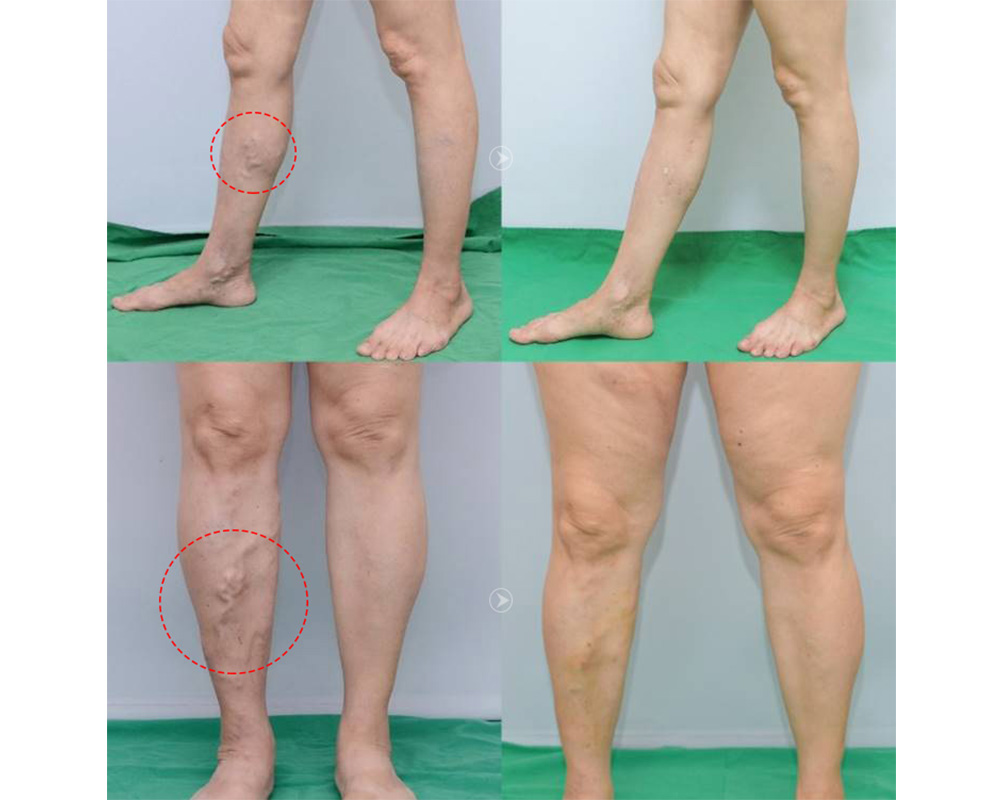 靜脈曲張-浮青筋-小腿爆青筋-靜脈曲張改善-靜脈曲張治療-體表血管雷射-微創血管手術-靜脈內雷射治療-皮膚管理專家-靜脈曲張手術推薦-靜脈曲張手術費用-EVLT