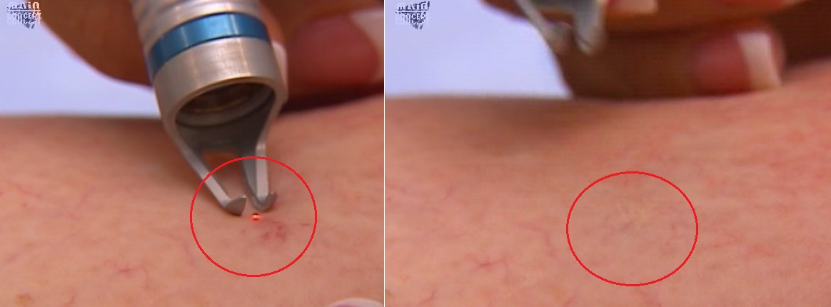 靜脈曲張-浮青筋-小腿爆青筋-靜脈曲張改善-靜脈曲張治療-體表血管雷射-微創血管手術-靜脈內雷射治療-EVLT-皮膚管理專家-靜脈曲張手術推薦-靜脈曲張手術費用