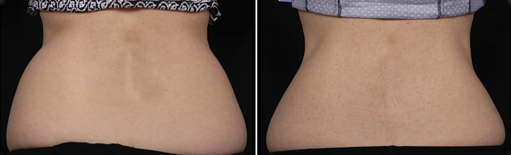 彤顏診所-CoolSculpting-酷塑-冷凍減脂-體外減脂-減肥-冷凍減脂手臂-冷凍減脂費用-瘦大腿-瘦身-瘦腰腹-瘦手臂-瘦小腹-冷凍減脂推薦