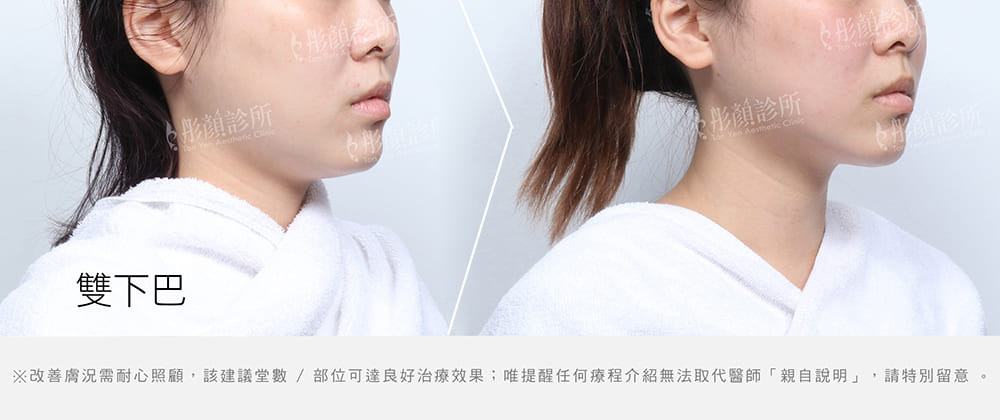 冷凍減脂-雙下巴-彤顏診所-雙下巴怎麼消-冷凍減脂費用-消脂針-桃園冷凍減脂推薦
