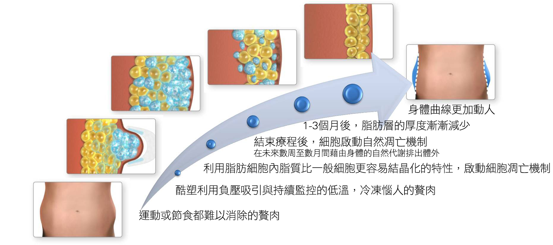 彤顏診所-CoolSculpting-酷塑-冷凍減脂-體外減脂-冷凍減脂手臂-冷凍減脂費用-瘦大腿-瘦身-瘦腰腹-瘦手臂-非侵入式減脂-冷凍減脂推薦-瘦小腹