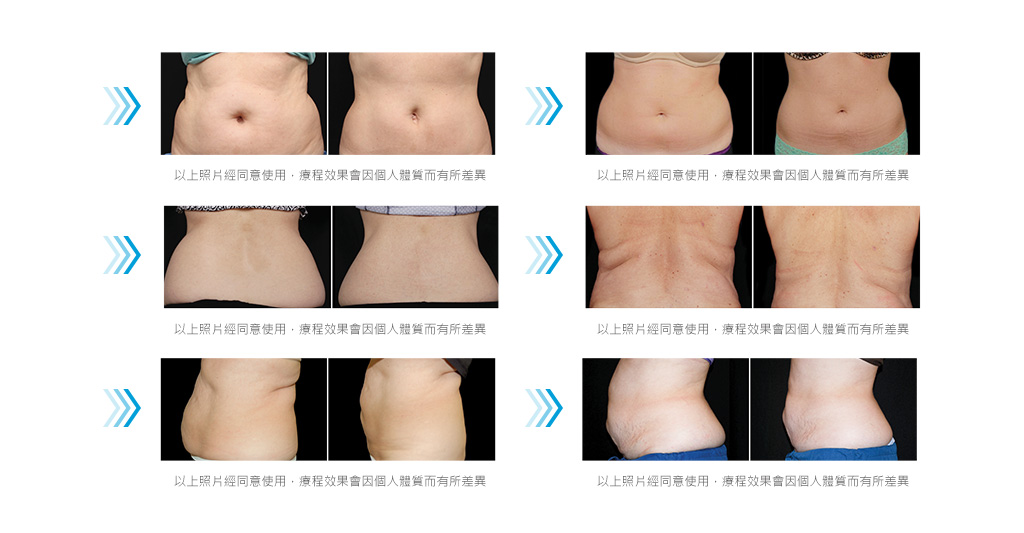 彤顏診所-減脂三重奏-隔空減脂-冷凍減脂-酷爾塑平-隔空溶脂-瘦小腹-coolsculpting溶脂-瘦身-瘦大腿-減肥-vanquish