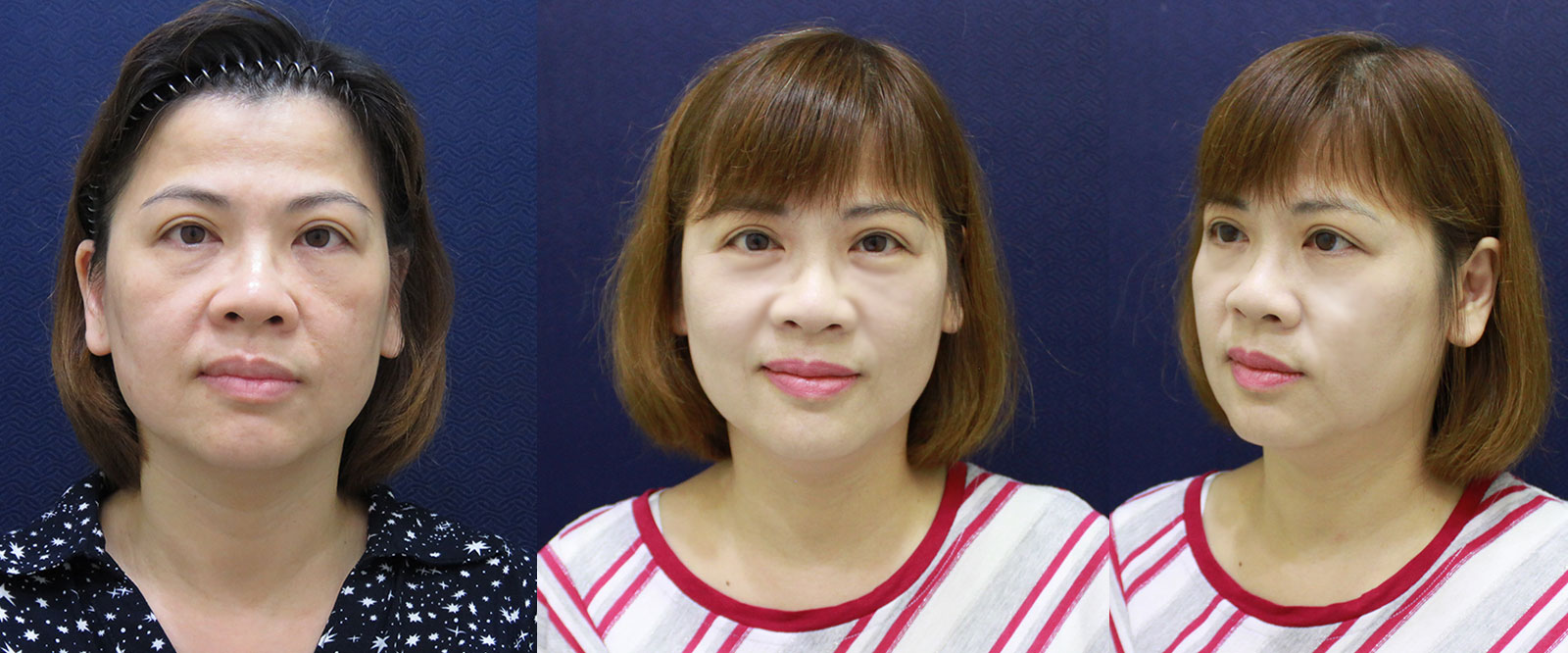 結構式線性拉提-線雕拉提-拉皮