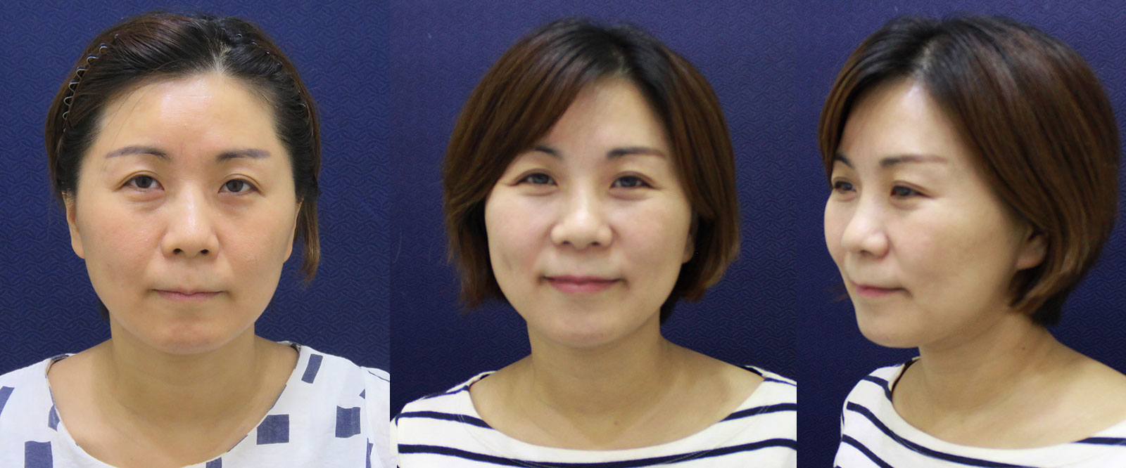 結構式線性拉提-線雕拉提-拉皮