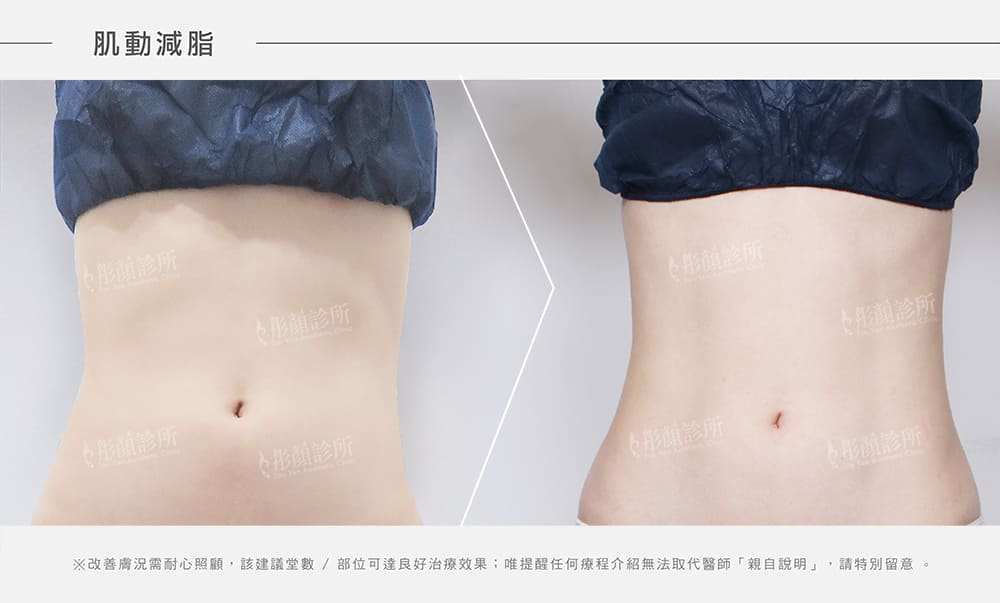 肌動減脂費用-馬甲線術前術後對比-瘦小腹-肌動減脂療程效果對比-增肌-減脂-腹直肌分離-腹直肌修復-快速瘦身-產後小腹肥胖-emsculpt-BTL