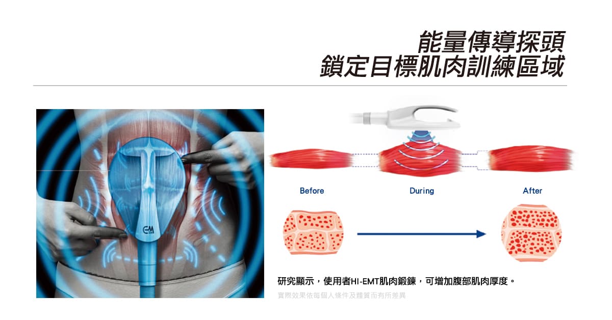 增肌減脂-CM SLIM-腹肌-增肌-馬甲線-腹肌訓練-川字肌-翹臀-減體脂肪-腹直肌-腹直 肌分離-二代增肌減脂儀