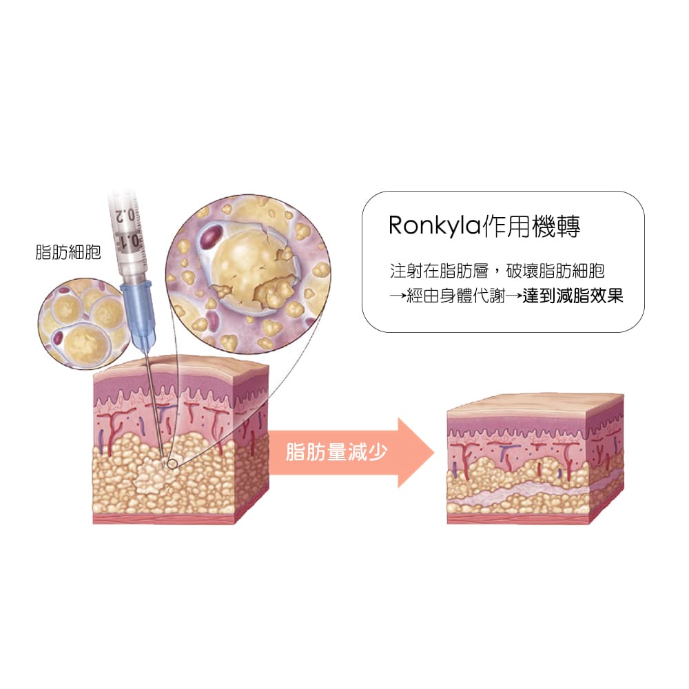 容脂針-消脂針-雙下巴-ronkyla-容脂針效果-醫美-容脂注射-消脂針效果