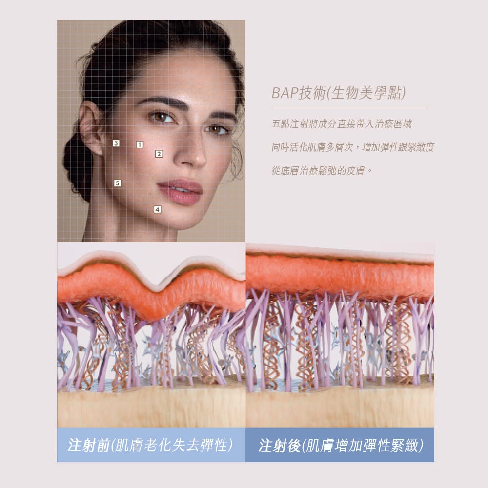 逆時針-profhilo效果-逆時針profhilo醫美醫美-逆時針效果-彈力蛋白針-桃園醫美-永和醫美