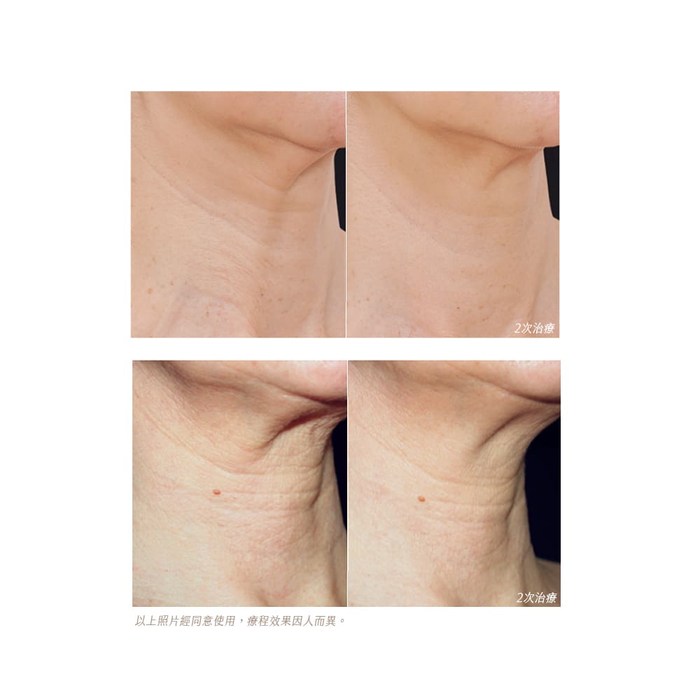 profhilo治療前後對比照-profhilo效果-profhilo醫美推薦-profhilo醫美