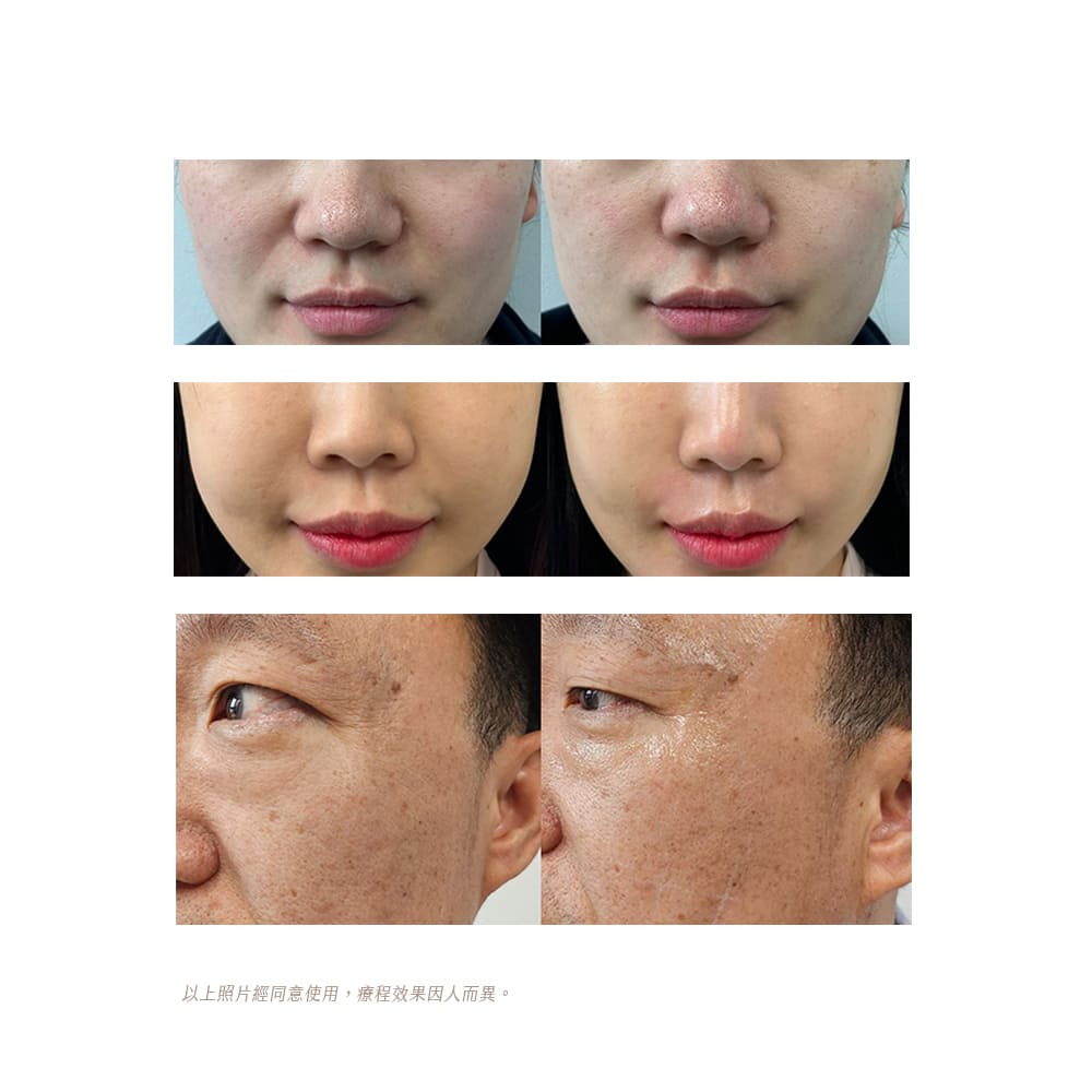 皇后電波Coolfase術前術後對比照-皇后電波拉提效果比對-皇后電波Coolfase醫美推薦-皇后電波Coolfase醫美